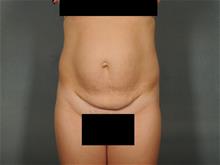 Tummy Tuck Before Photo by Ellen Janetzke, MD; Bloomfield Hills, MI - Case 29104