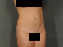 Tummy Tuck After Photo by Ellen Janetzke, MD; Bloomfield Hills, MI - Case 29104