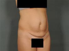 Tummy Tuck Before Photo by Ellen Janetzke, MD; Bloomfield Hills, MI - Case 29104
