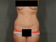 Tummy Tuck After Photo by Ellen Janetzke, MD; Bloomfield Hills, MI - Case 29150