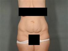 Tummy Tuck Before Photo by Ellen Janetzke, MD; Bloomfield Hills, MI - Case 29150