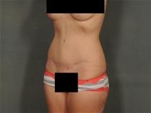 Tummy Tuck After Photo by Ellen Janetzke, MD; Bloomfield Hills, MI - Case 29150