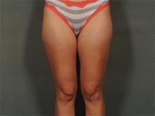 Liposuction After Photo by Ellen Janetzke, MD; Bloomfield Hills, MI - Case 29151