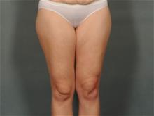 Liposuction Before Photo by Ellen Janetzke, MD; Bloomfield Hills, MI - Case 29151
