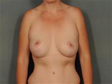 Breast Lift After Photo by Ellen Janetzke, MD; Bloomfield Hills, MI - Case 29152