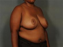 Breast Reduction After Photo by Ellen Janetzke, MD; Bloomfield Hills, MI - Case 29159