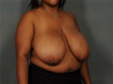 Breast Reduction Before Photo by Ellen Janetzke, MD; Bloomfield Hills, MI - Case 29159