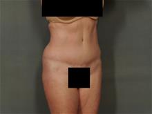 Tummy Tuck After Photo by Ellen Janetzke, MD; Bloomfield Hills, MI - Case 29173