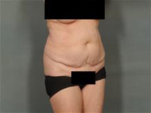 Tummy Tuck Before Photo by Ellen Janetzke, MD; Bloomfield Hills, MI - Case 29173
