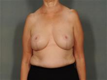 Breast Reduction After Photo by Ellen Janetzke, MD; Bloomfield Hills, MI - Case 29230