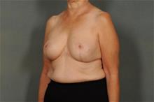 Breast Reduction After Photo by Ellen Janetzke, MD; Bloomfield Hills, MI - Case 29230