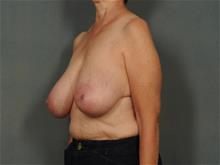 Breast Reduction Before Photo by Ellen Janetzke, MD; Bloomfield Hills, MI - Case 29230