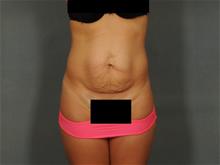 Tummy Tuck Before Photo by Ellen Janetzke, MD; Bloomfield Hills, MI - Case 29231