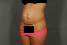 Tummy Tuck Before Photo by Ellen Janetzke, MD; Bloomfield Hills, MI - Case 29231