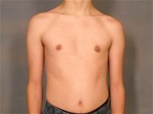 Male Breast Reduction After Photo by Ellen Janetzke, MD; Bloomfield Hills, MI - Case 29232