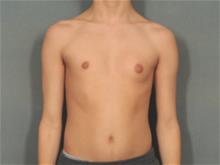 Male Breast Reduction Before Photo by Ellen Janetzke, MD; Bloomfield Hills, MI - Case 29232
