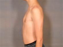 Male Breast Reduction After Photo by Ellen Janetzke, MD; Bloomfield Hills, MI - Case 29232