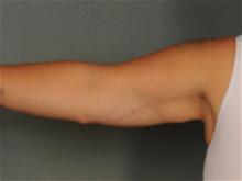 Arm Lift After Photo by Ellen Janetzke, MD; Bloomfield Hills, MI - Case 29243