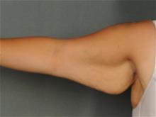 Arm Lift Before Photo by Ellen Janetzke, MD; Bloomfield Hills, MI - Case 29243