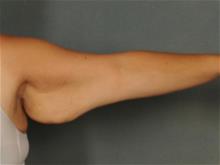 Arm Lift Before Photo by Ellen Janetzke, MD; Bloomfield Hills, MI - Case 29243