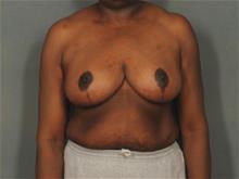 Breast Reduction After Photo by Ellen Janetzke, MD; Bloomfield Hills, MI - Case 29244