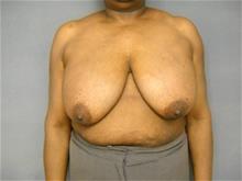 Breast Reduction Before Photo by Ellen Janetzke, MD; Bloomfield Hills, MI - Case 29244