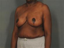 Breast Reduction After Photo by Ellen Janetzke, MD; Bloomfield Hills, MI - Case 29244