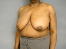 Breast Reduction Before Photo by Ellen Janetzke, MD; Bloomfield Hills, MI - Case 29244