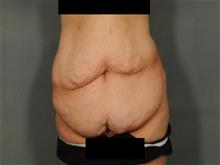 Tummy Tuck Before Photo by Ellen Janetzke, MD; Bloomfield Hills, MI - Case 29245