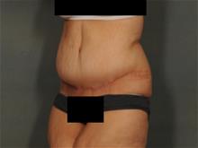 Tummy Tuck After Photo by Ellen Janetzke, MD; Bloomfield Hills, MI - Case 29245