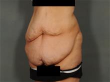 Tummy Tuck Before Photo by Ellen Janetzke, MD; Bloomfield Hills, MI - Case 29245
