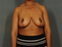 Breast Reduction After Photo by Ellen Janetzke, MD; Bloomfield Hills, MI - Case 29287