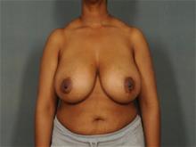 Breast Reduction Before Photo by Ellen Janetzke, MD; Bloomfield Hills, MI - Case 29287