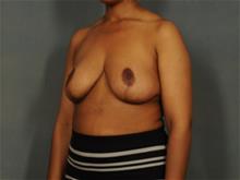 Breast Reduction After Photo by Ellen Janetzke, MD; Bloomfield Hills, MI - Case 29287