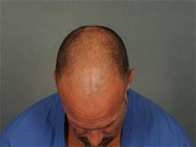 Hair Transplant Before Photo by Ellen Janetzke, MD; Bloomfield Hills, MI - Case 29289