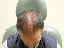 Hair Transplant After Photo by Ellen Janetzke, MD; Bloomfield Hills, MI - Case 29289
