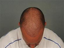 Hair Transplant Before Photo by Ellen Janetzke, MD; Bloomfield Hills, MI - Case 29289
