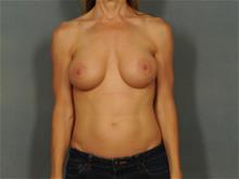 Breast Augmentation After Photo by Ellen Janetzke, MD; Bloomfield Hills, MI - Case 29290