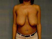 Breast Reduction Before Photo by Ellen Janetzke, MD; Bloomfield Hills, MI - Case 29307