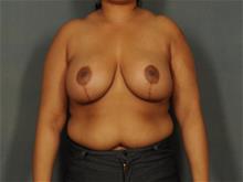 Breast Reduction After Photo by Ellen Janetzke, MD; Bloomfield Hills, MI - Case 29353