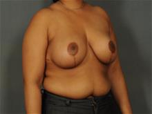 Breast Reduction After Photo by Ellen Janetzke, MD; Bloomfield Hills, MI - Case 29353
