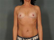 Breast Augmentation Before Photo by Ellen Janetzke, MD; Bloomfield Hills, MI - Case 29354