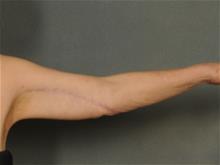 Arm Lift After Photo by Ellen Janetzke, MD; Bloomfield Hills, MI - Case 29402