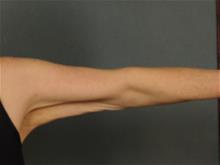 Arm Lift Before Photo by Ellen Janetzke, MD; Bloomfield Hills, MI - Case 29402