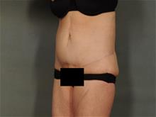Tummy Tuck After Photo by Ellen Janetzke, MD; Bloomfield Hills, MI - Case 29403