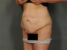 Tummy Tuck Before Photo by Ellen Janetzke, MD; Bloomfield Hills, MI - Case 29403
