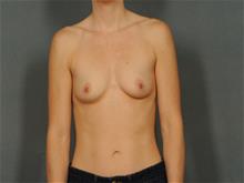 Breast Augmentation Before Photo by Ellen Janetzke, MD; Bloomfield Hills, MI - Case 29411