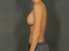 Breast Augmentation After Photo by Ellen Janetzke, MD; Bloomfield Hills, MI - Case 29411