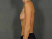 Breast Augmentation Before Photo by Ellen Janetzke, MD; Bloomfield Hills, MI - Case 29411
