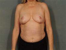 Breast Reduction After Photo by Ellen Janetzke, MD; Bloomfield Hills, MI - Case 29420